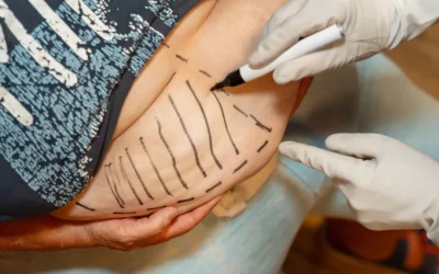 According to the ruling, health insurance companies have to pay for skin tightening – in these cases