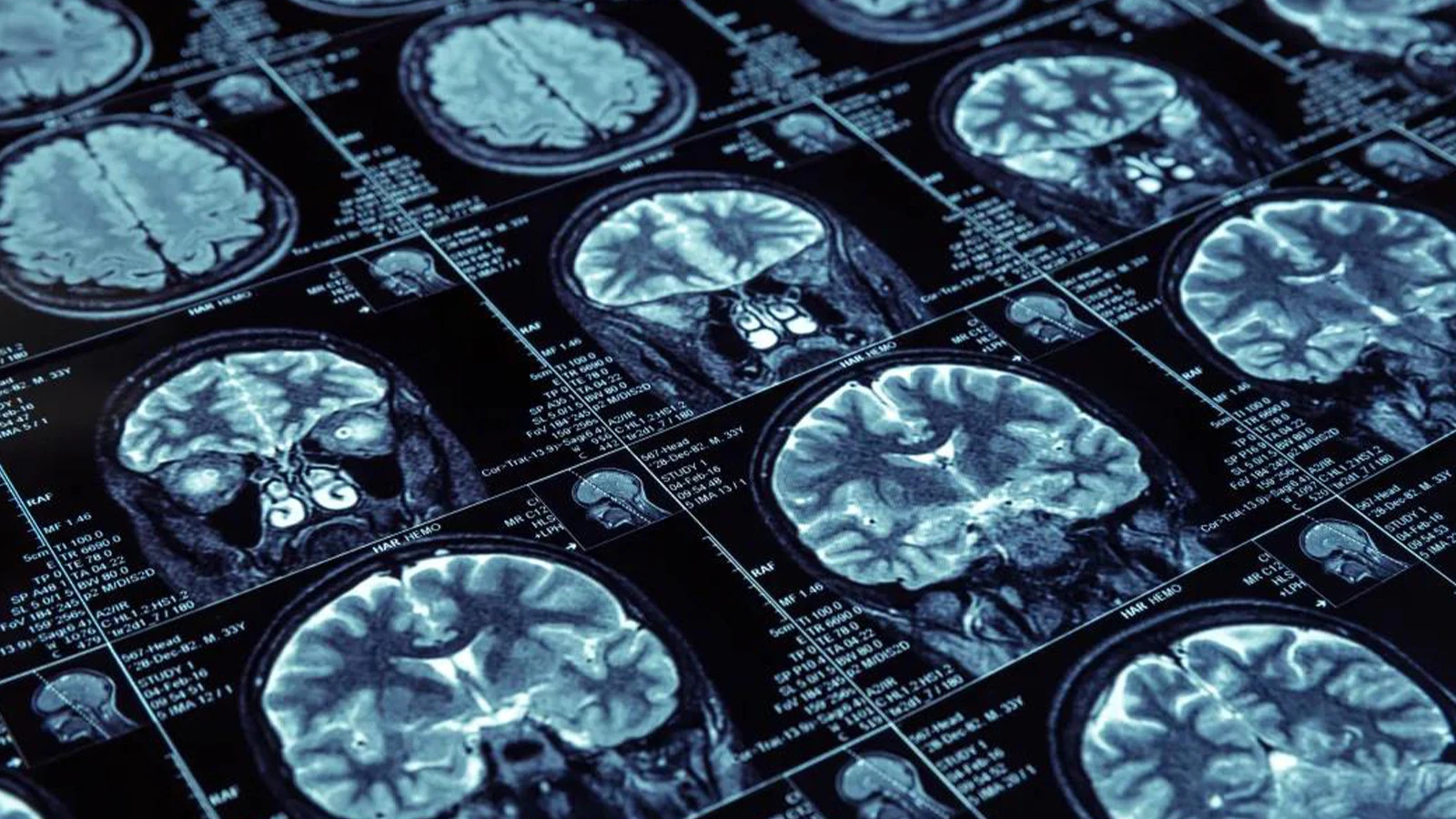 "Dementia" research in the USA: These 3 habits can delay the disease by 13 years